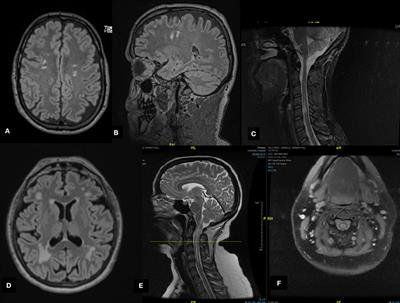 Case Series: Myelin Oligodendrocyte Glycoprotein-Immunoglobulin G-Related Disease Spectrum